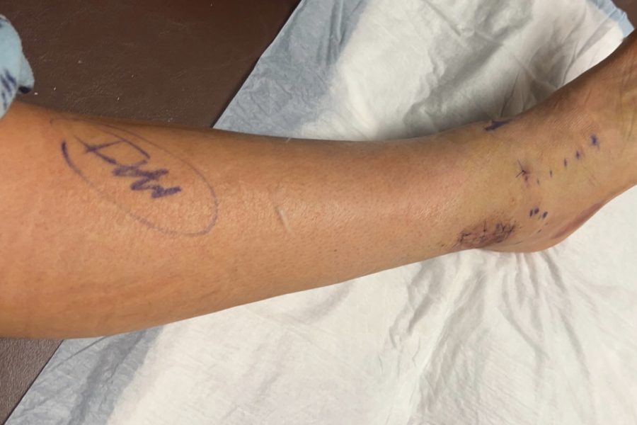 Kupbens’ leg post-surgery after getting a TightRope put in, a metal plate with wires that go through the bones to hold them together in place of her ligament.