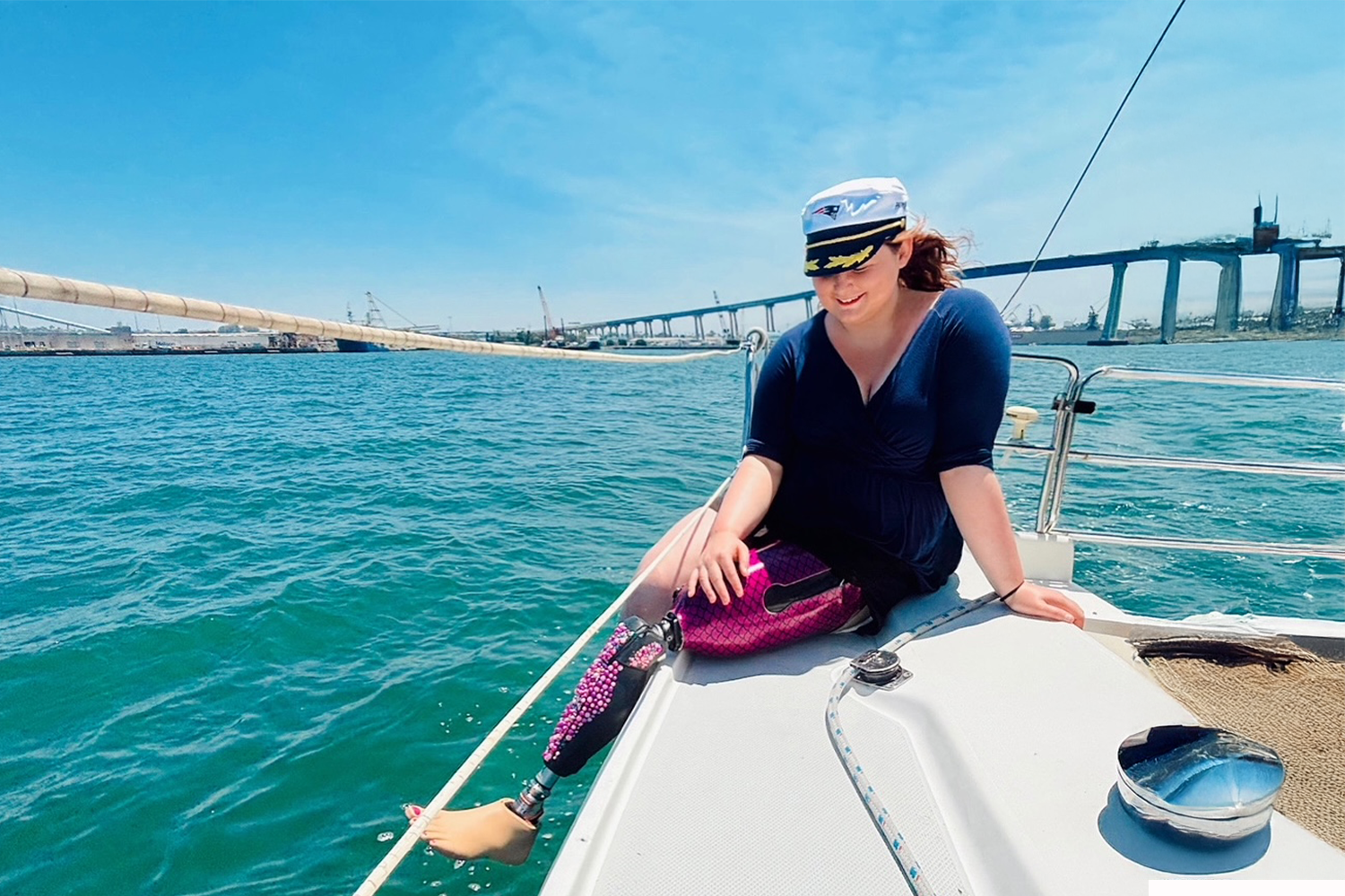 After losing her leg, Sydney Marshburn refused to let amputation define the boundaries of her life. An avid adventurer and advocate for accessibility, she continues to embrace the outdoors with strength and optimism. Whether sailing across open water or sharing her story to inspire others, Marshburn demonstrates that recovery is not just about mobility, it’s about rediscovering freedom. Her prosthesis, customized for both comfort and expression, represents more than technology; it’s a symbol of adaptation, confidence, and individuality.